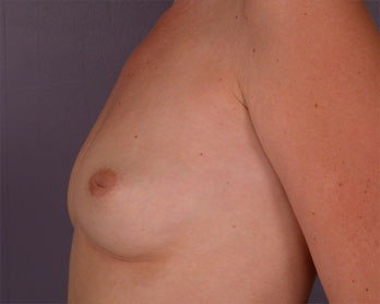 Nipple - Inversion Correction before and after photo