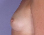 Nipple - Inversion Correction Before and after photo