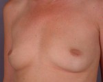 Nipple - Inversion Correction Before and after photo