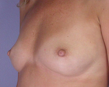 Nipple - Inversion Correction before and after photo