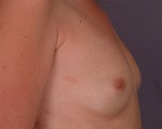 Nipple - Inversion Correction Before and after photo