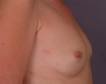 Nipple - Inversion Correction before and after photo