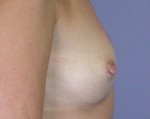 Nipple - Inversion Correction Before and after photo