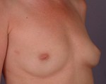 Nipple - Inversion Correction Before and after photo