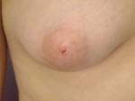 Nipple - Inversion Correction
