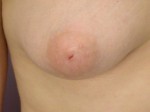 Nipple - Inversion Correction Before and after photo