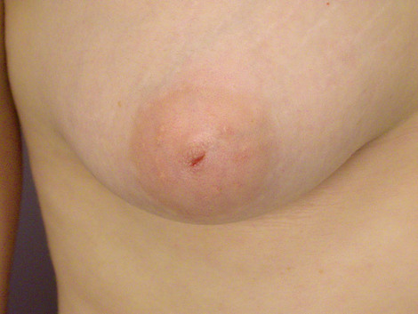 Nipple - Inversion Correction before and after photo