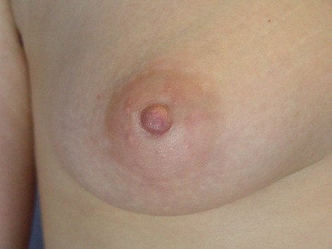 Nipple - Inversion Correction before and after photo