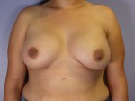 Nipple - Inversion Correction Before and after photo