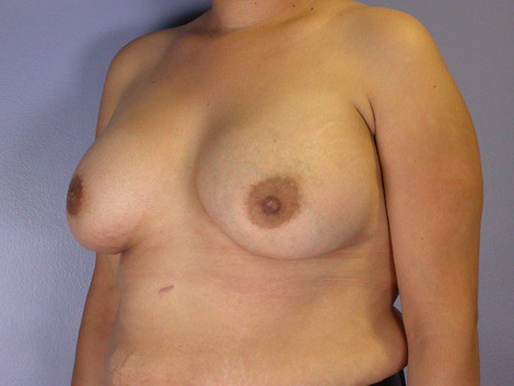 Nipple - Inversion Correction before and after photo