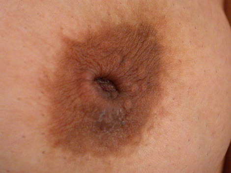 Nipple - Inversion Correction before and after photo