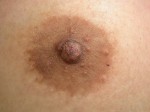 Nipple - Inversion Correction Before and after photo