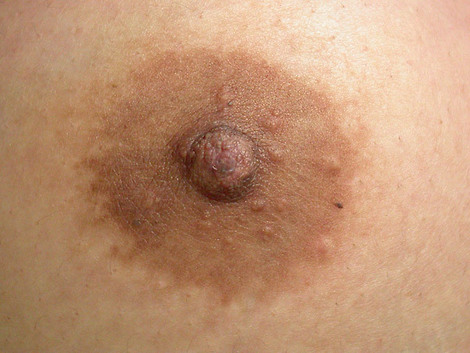 Nipple - Inversion Correction before and after photo