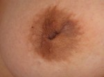 Nipple - Inversion Correction Before and after photo