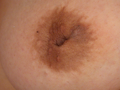 Nipple - Inversion Correction before and after photo