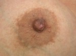 Nipple - Inversion Correction Before and after photo