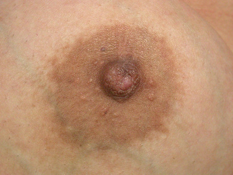 Nipple - Inversion Correction before and after photo