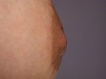 Nipple - Inversion Correction Before and after photo