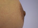 Nipple - Inversion Correction Before and after photo