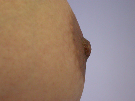 Nipple - Inversion Correction before and after photo