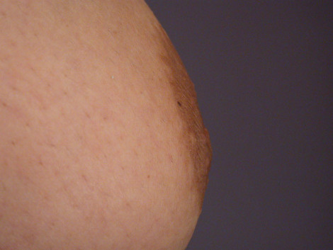 Nipple - Inversion Correction before and after photo