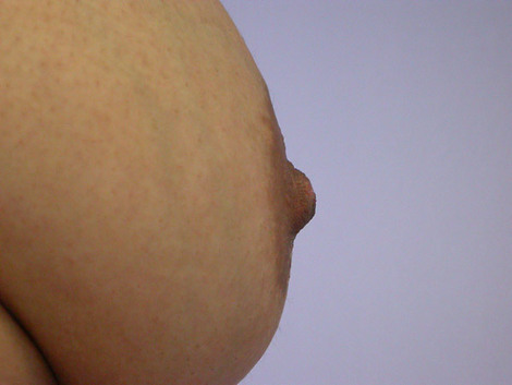 Nipple - Inversion Correction before and after photo