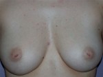 Nipple - Inversion Correction Before and after photo