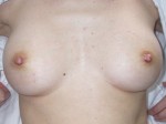 Nipple - Inversion Correction Before and after photo