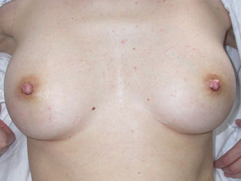 Nipple - Inversion Correction before and after photo