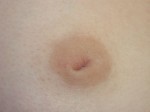 Nipple - Inversion Correction Before and after photo