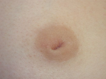 Nipple - Inversion Correction before and after photo