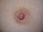 Nipple - Inversion Correction Before and after photo