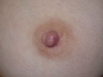 Nipple - Inversion Correction before and after photo