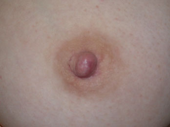 Nipple - Inversion Correction before and after photo