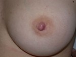 Nipple - Inversion Correction Before and after photo