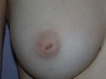 Nipple - Inversion Correction Before and after photo