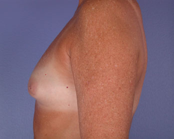 Nipple - Inversion Correction before and after photo