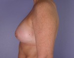 Nipple - Inversion Correction Before and after photo