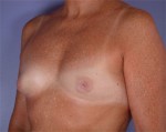 Nipple - Inversion Correction Before and after photo