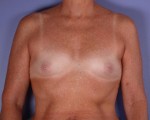 Nipple - Inversion Correction Before and after photo