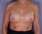 Nipple - Inversion Correction Before and after photo