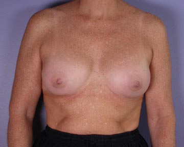 Nipple - Inversion Correction before and after photo