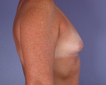 Nipple - Inversion Correction before and after photo