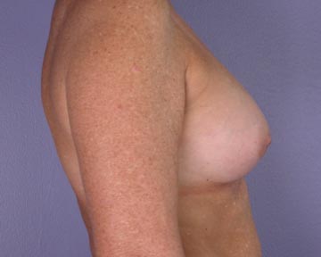 Nipple - Inversion Correction before and after photo