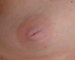 Nipple - Inversion Correction Before and after photo