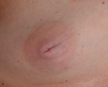 Nipple - Inversion Correction before and after photo