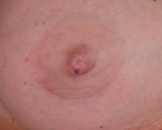 Nipple - Inversion Correction Before and after photo