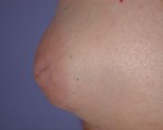 Nipple - Inversion Correction Before and after photo