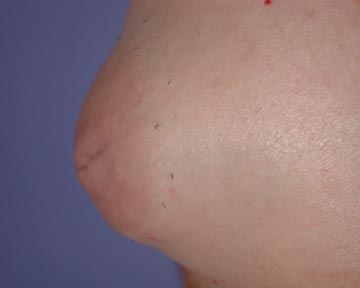 Nipple - Inversion Correction before and after photo