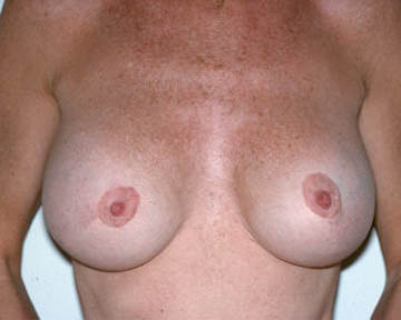 Breast Implant Removal before and after photo